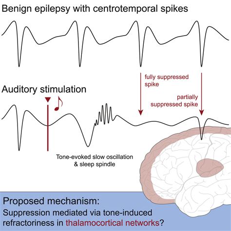 Auditory Stimulation During Sleep Suppresses Spike Activity In Benign