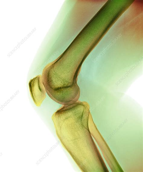 Normal Knee X Ray Stock Image F0033608 Science Photo Library