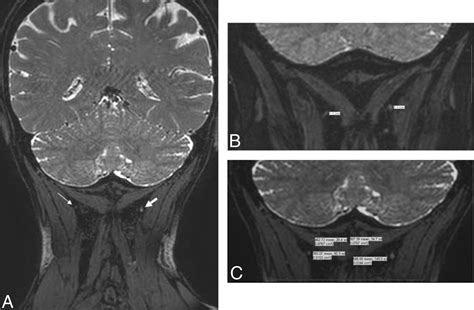 Occipital Neuralgia Sonoanatomy And Sonopathology Of The Occipital