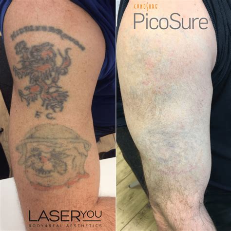 Laser Tattoo Removal Picosure Tattoo Removal Aerolase Skin