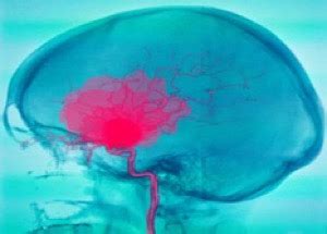 Brain injuries can forever change one's life in an instant. Brain Bleed Injury | Buffalo Accident Lawyers Dietrich Law Firm