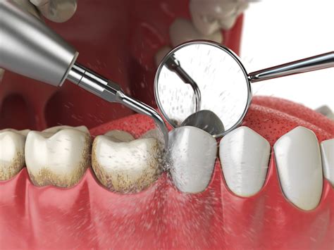 Scaling And Root Planning — Dentistry Ingleside