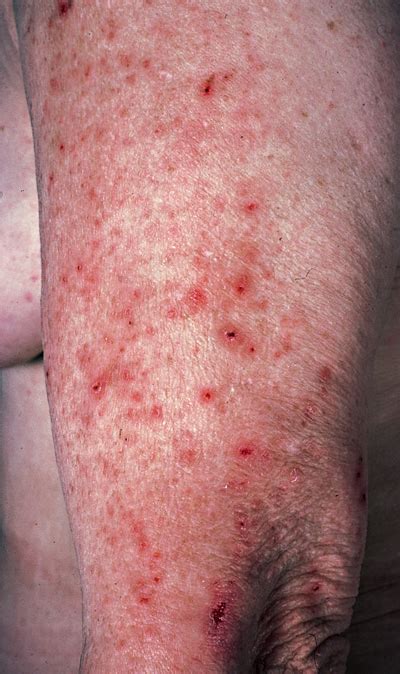 Dermatitis Herpetiformis Coeliac Uk