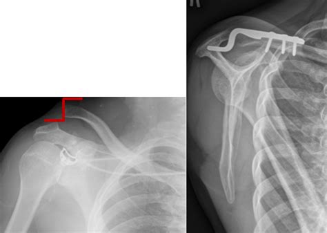 Collar Bone Dislocation Surgery Singapore Orthopedic Specialist