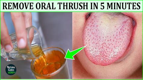 How To Get Rid Of Oral Thrush Naturally In 5 Minutes Oral Thrush Home Remedies Youtube