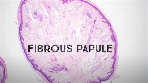 Fibrous Papule Angiofibroma Skin Bump On Nose Mimic Of Basal Cell