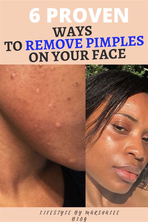 6 Proven Ways To Remove Pimples On Your Face In 2020 How To Get Rid