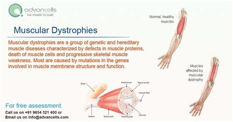 Types Of Muscular Dystrophy And Its Symptoms Advancells