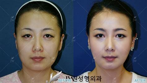 Facial Bone Contouring Cheekbone Reduction Square Jaw Reduction