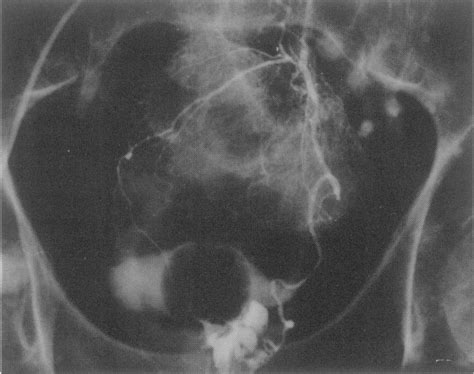 Figure Selective Inferior Mesenteric Angiogram Showing The Ectatic