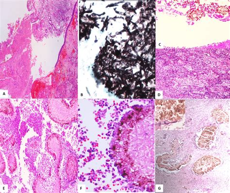 A Nasal Polyp With Allergic Fungal Rhinosinusitis With Allergic Mucin