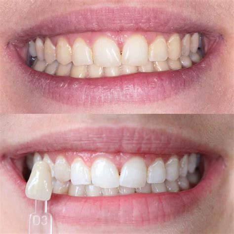 Enlighten Teeth Whitening Far Headingley Dental Care Dentist In Leeds