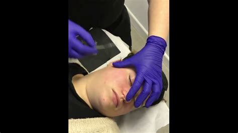 Dermaplaning Demonstration Tutorial How To Do The Nose Professionals