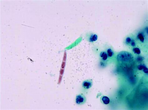 Diagnosis Of Fusariosis In Urine Cytology Journal Of Clinical Pathology