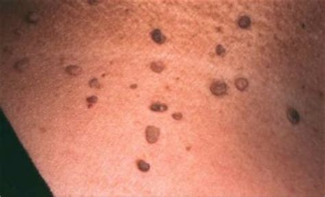 Some dryness may come with pain and itchiness of the skin. Skin Tags - The Skin Center: Board-Certified ...