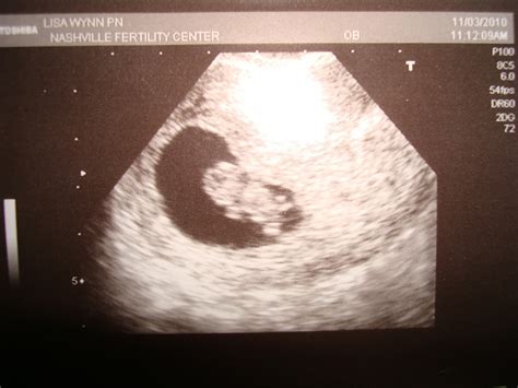 Our Baby Journey 2nd Ultrasound 8 Weeks And 4 Days