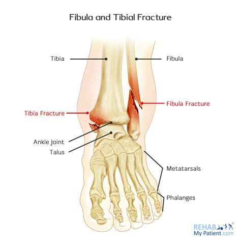 Ankle Fractures Tibia And Fibula Orthopaedia My Xxx Hot Girl