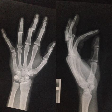 Double Finger Dislocation Middle And Ring And Small Fracture On Index