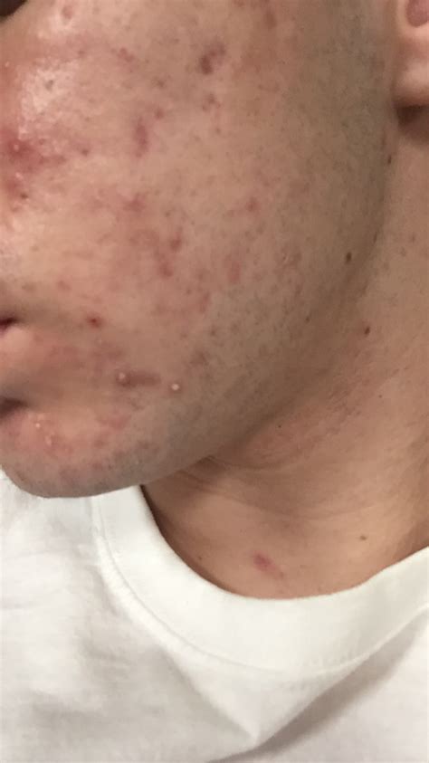 17 Year Old Severe Acne Scars And Redness General Acne Discussion