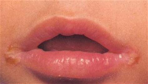 Yeast infection on lips and in the mouth can cause sores of different types. Doctors Gates: Angular stomatitis: can be treated at home!!