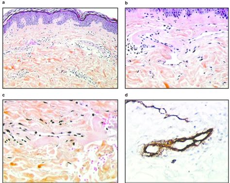 A Histologic Examination Of A Skin Biopsy Shows In The Papillary