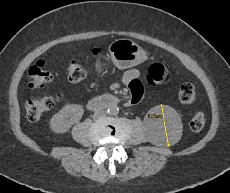 Cystic Left Renal Cell Carcinoma Kidney Case Studies Ctisus Ct Scanning