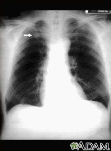 Pulmonary Nodule Front View Chest X Ray Medlineplus Medical Encyclopedia Image