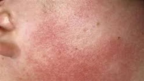How To Get Rid Of Keratosis Pilaris On Face Youtube