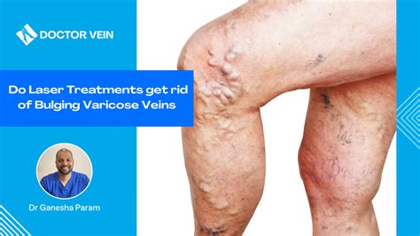 Do Laser Treatments Get Rid Of Bulging Varicose Veins