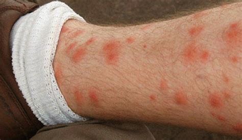 Red Spots On Legs Pictures Symptoms Causes Treatment Healthmd