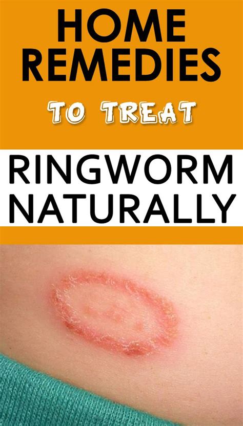 Home Remedies To Treat Ringworm Naturally Ringworm Remedies Home
