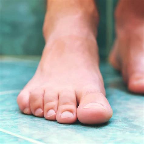 What Causes Thick Toenails Causes Symptoms And Treatments To Get Rid