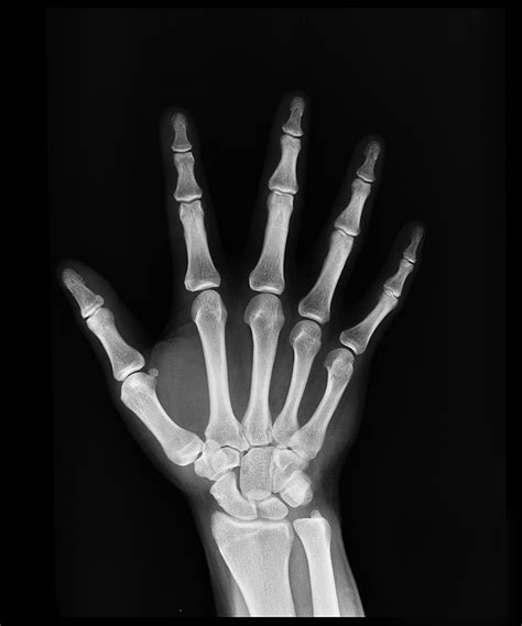 Hand X Ray