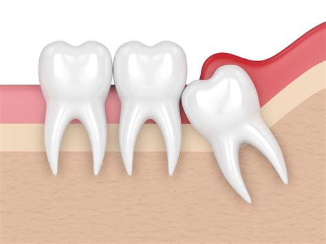 What Is A Partially Impacted Tooth Maxillofacial Explanations