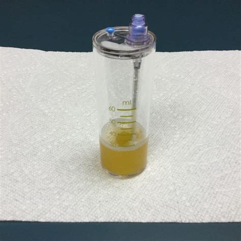 Platelet Rich Plasma PRP Naturopathic Doctor News And Review