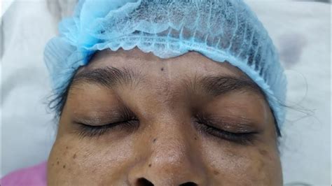 Removal Of Dermoid Cyst At Medial Canthus Eye With Scar Revision