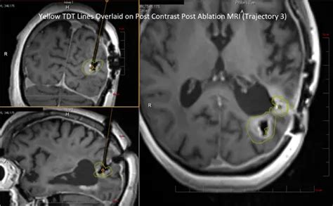Left Awake Craniotomy And Laser Interstitial Thermal Therapy Litt For