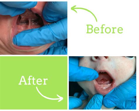labial frenectomy before and after