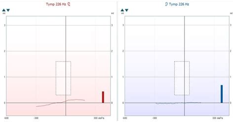 Results Of Classical Tympanometry For Hz Right And Left Ear