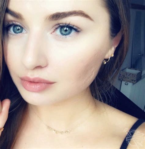 This Girl Developed Severe Cystic Acne That Left Her Face Permanently