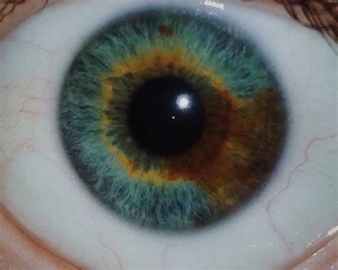 My Left Eye Has Both Sectoral And Central Heterochromia My Grandma