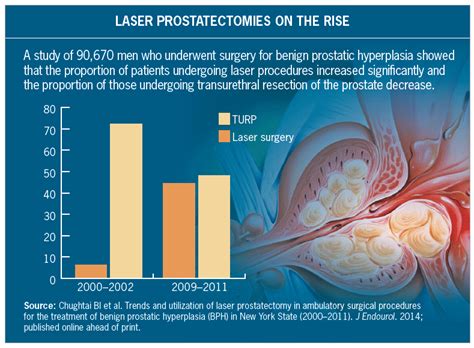 Laser Surgery Gaining On Transurethral Resection Turp For Enlarged Prostate Renal And