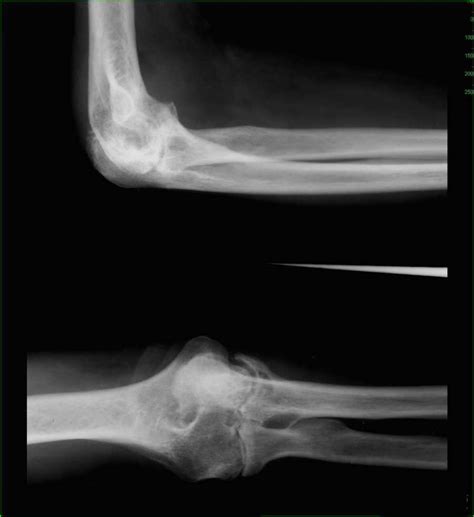 Rheumatoid Arthritis Of Elbow On X Ray X Rays Case Studies Ctisus