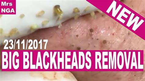 Big Blackheads Removal Youtube