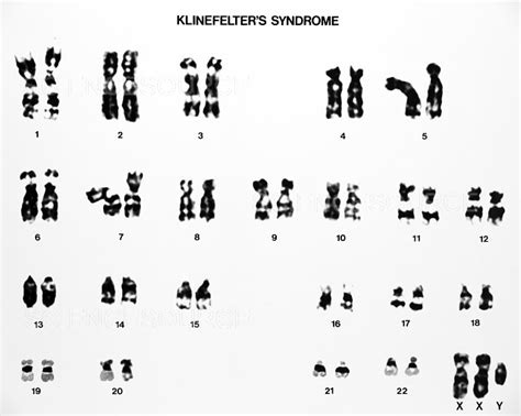 Photograph Klinefelters Syndrome Karyotype Science Source Images