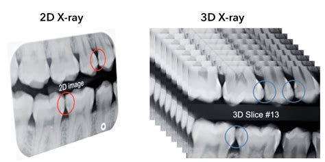 Fda Clears New 3d Dental X Ray Device Based On Unc Research Unc