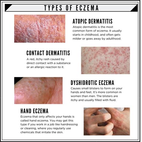 7 Types Of Eczema Pictures And Differences Between Them