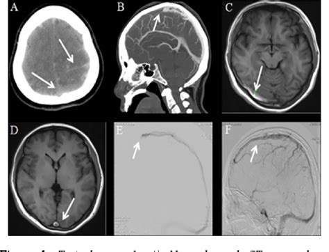 Figure 1 From Cerebral Venous Sinus Thrombosis And Acute Subarachnoid