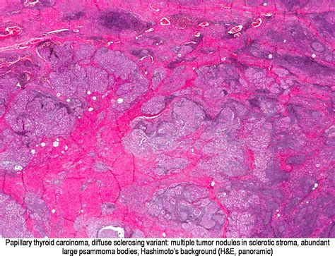 Pathology Outlines Diffuse Sclerosing Variant