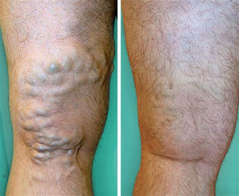 Varicose Vein Patient Lam Vascular